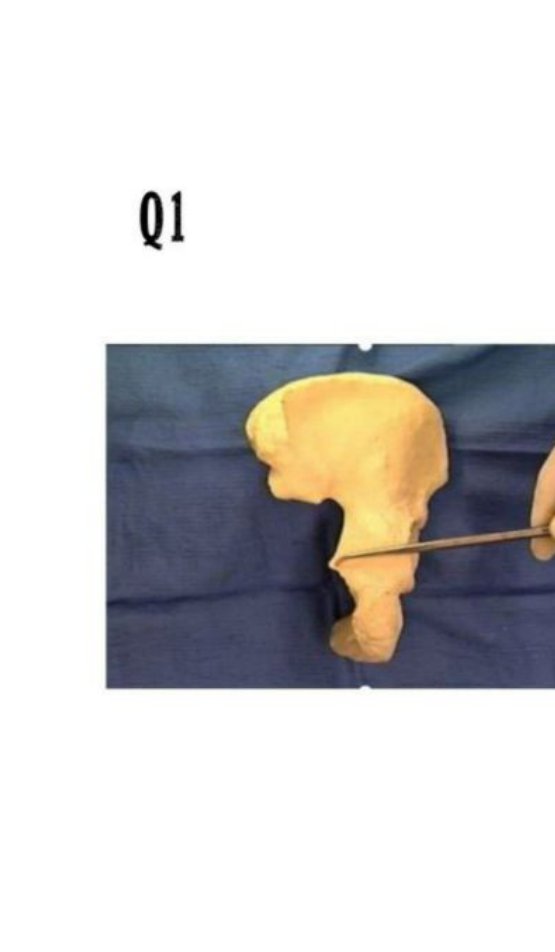 Hip bone specimen with a probe pointing to a bony spine on the ischium