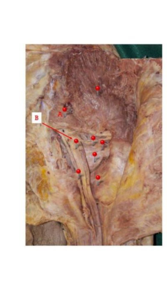 Gluteal dissection with muscle A and nerve B labelled