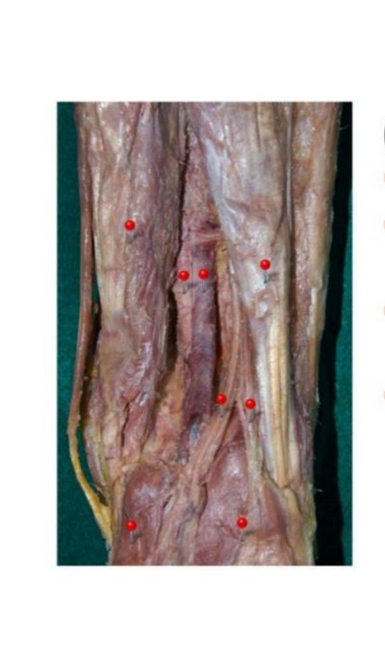 Posterior knee dissection with hamstring muscles A and B labelled