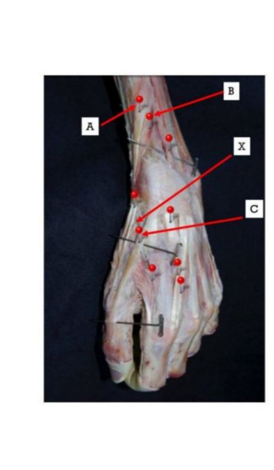 Dorsum of the hand and wrist with tendons A, B, C and region X labelled