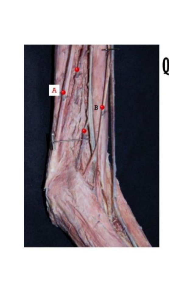 Cubital fossa dissection with nerves A and B labelled