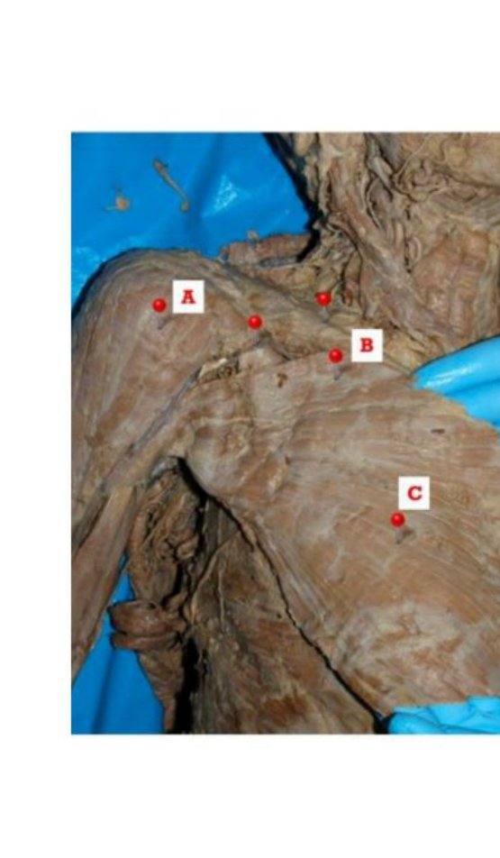 Shoulder dissection with deltoid (A), pectoralis major (B), and muscle C labelled