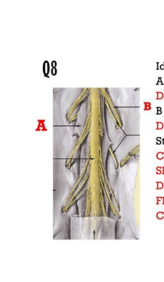 Illustration of the spinal cord in the vertebral canal with denticulate ligament (A) and dorsal nerve root (B) labelled