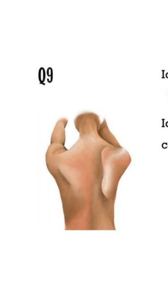 Illustration of a winged scapula seen from behind