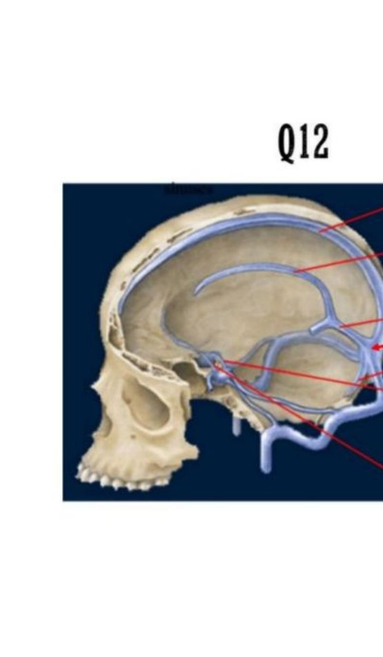 Sagittal skull illustration with dural venous sinuses A, B, C, D labelled