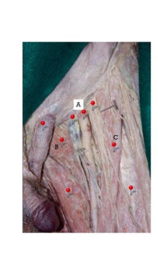 Femoral triangle dissection with femoral artery (A), pectineus (B), and sartorius (C) labelled