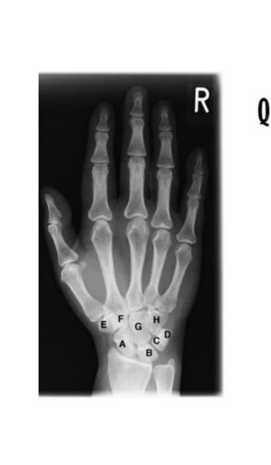 Wrist and hand radiograph with carpal bones A-H labelled
