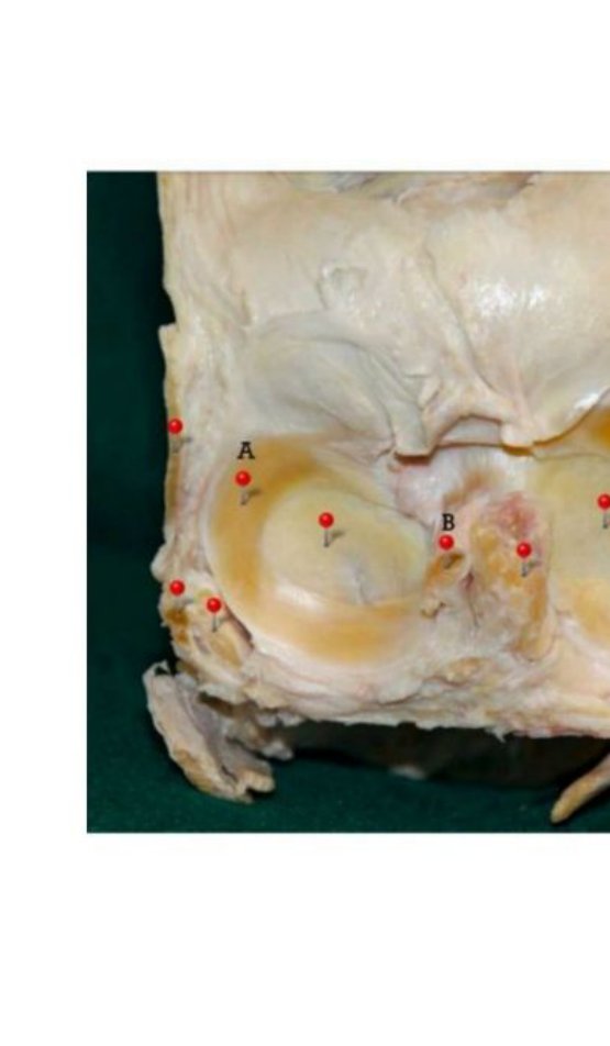 Knee joint dissection with lateral meniscus (A) and anterior cruciate ligament (B) labelled