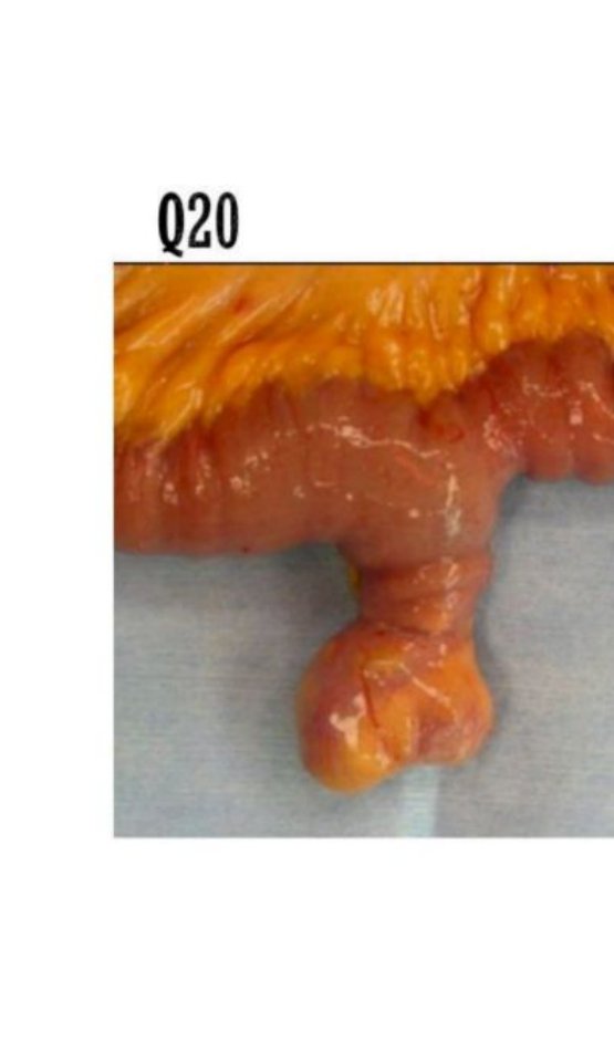 Photo of an intestinal segment with a small blind-ended outpouching