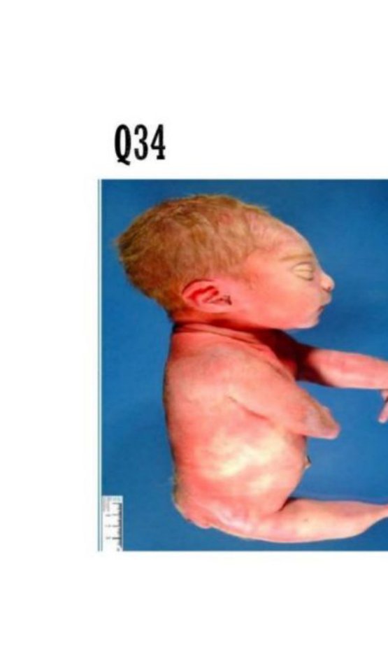 Clinical photo of a neonate with a lower-body/sacral congenital anomaly