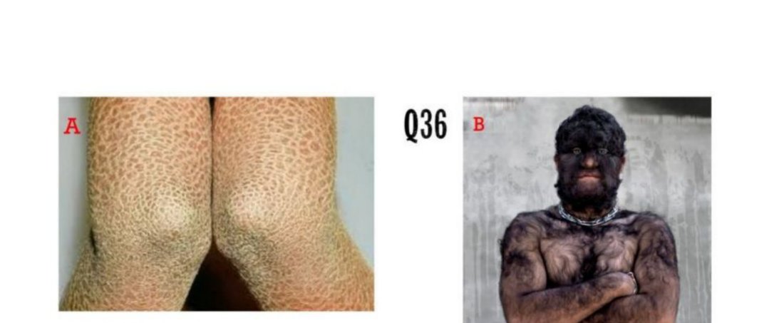 Two clinical photos: A, thickened scaly skin over the knees; B, a man with excessive body and facial hair