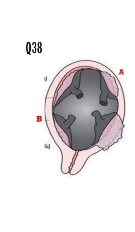 Diagram of an abnormally adherent placenta with regions A and B labelled