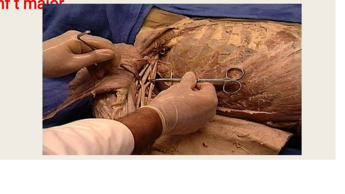 Q3 - forceps tagging a vessel in the axilla