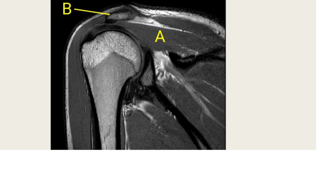 Q16 - shoulder MRI with A and B labelled