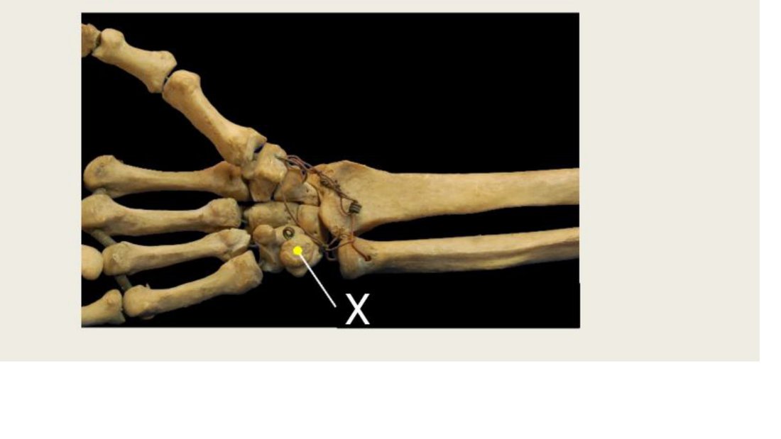 Q27 - wrist skeleton with a carpal bone tagged X