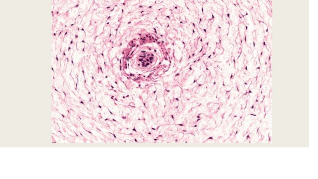 Q35 - mucoid connective tissue