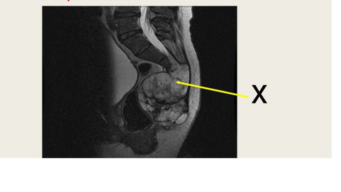 Q43 - sagittal MRI of the lower spine showing a mass