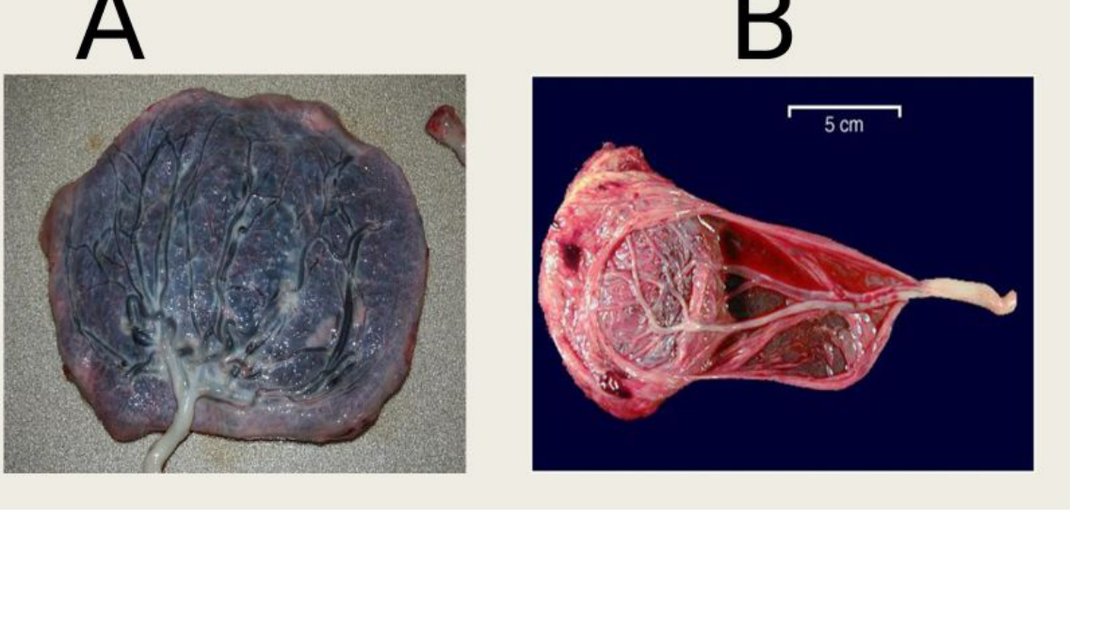 Q45 - two placental specimens