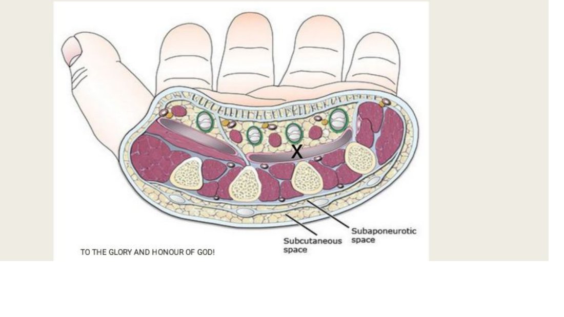Q23 - diagram of the palm with a fascial space labelled X
