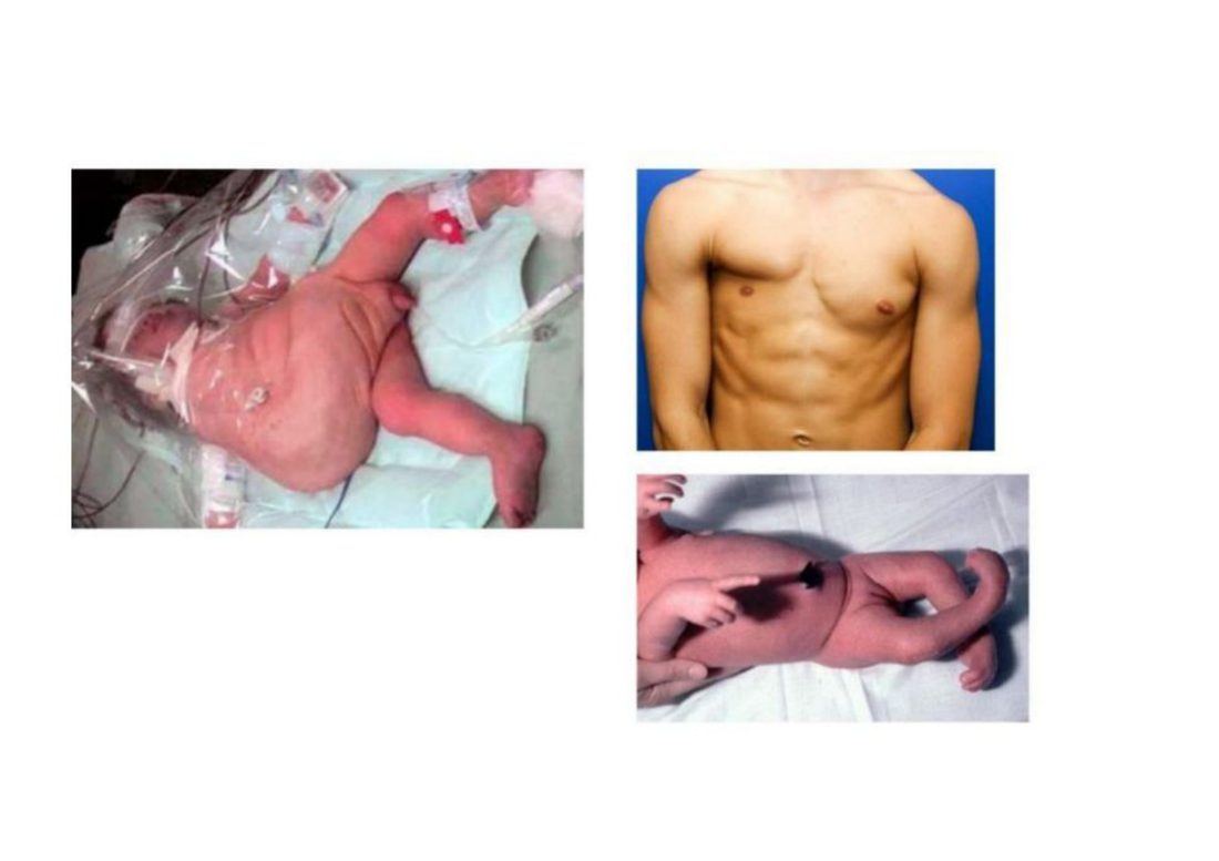Number 10 - three anterior abdominal wall anomaly photos