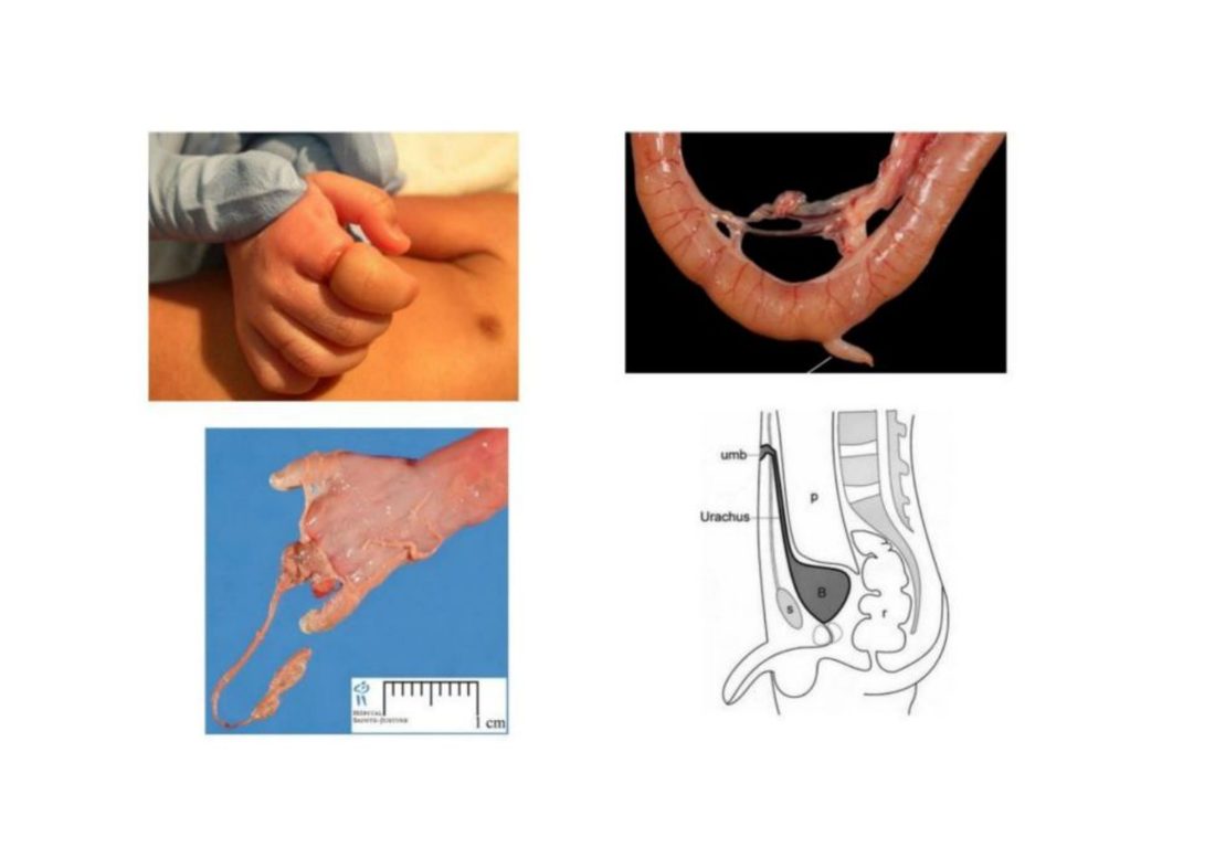 Number 11 (continued) - result of craniocaudal and lateral folding