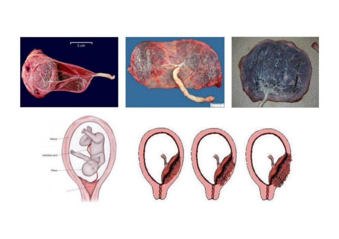 Number 14 - several placenta specimens, normal and abnormal
