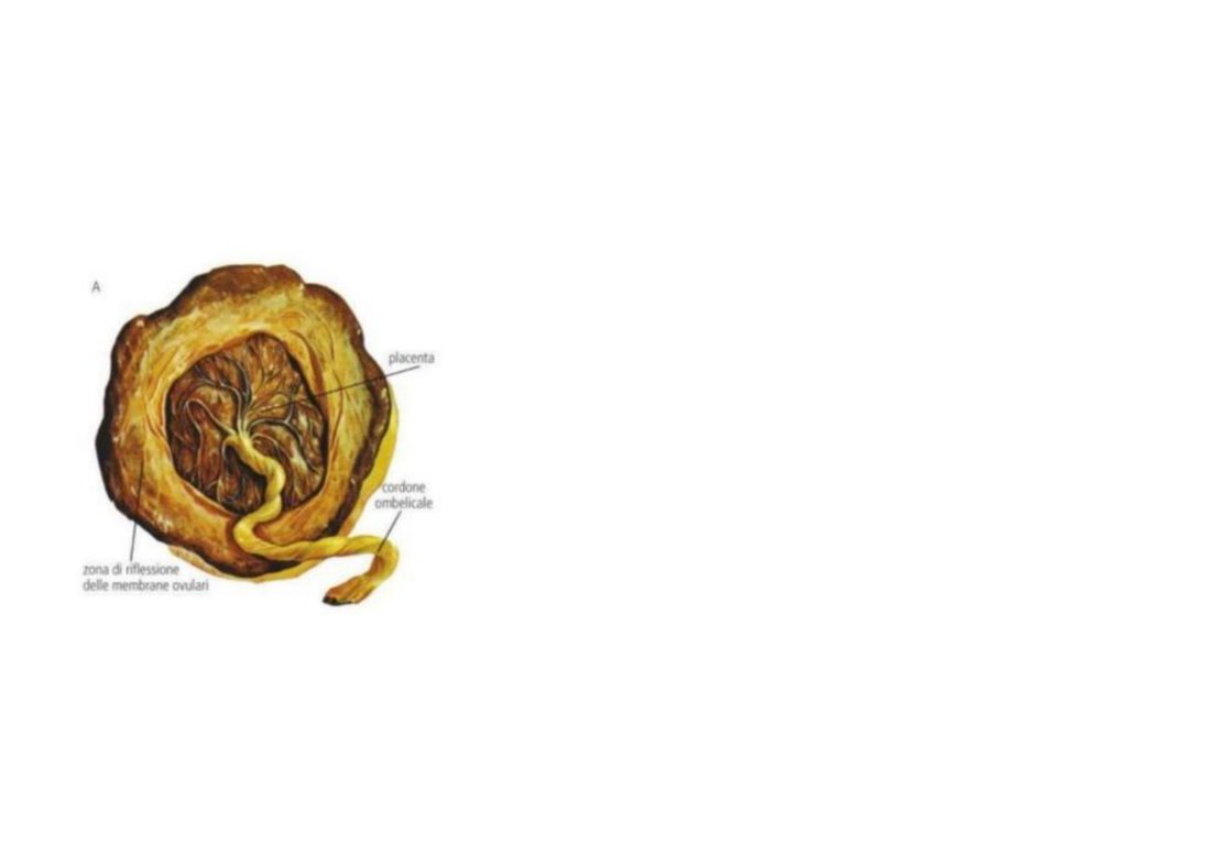 Number 16 - placenta specimen with the fetal membranes doubled back at the margin