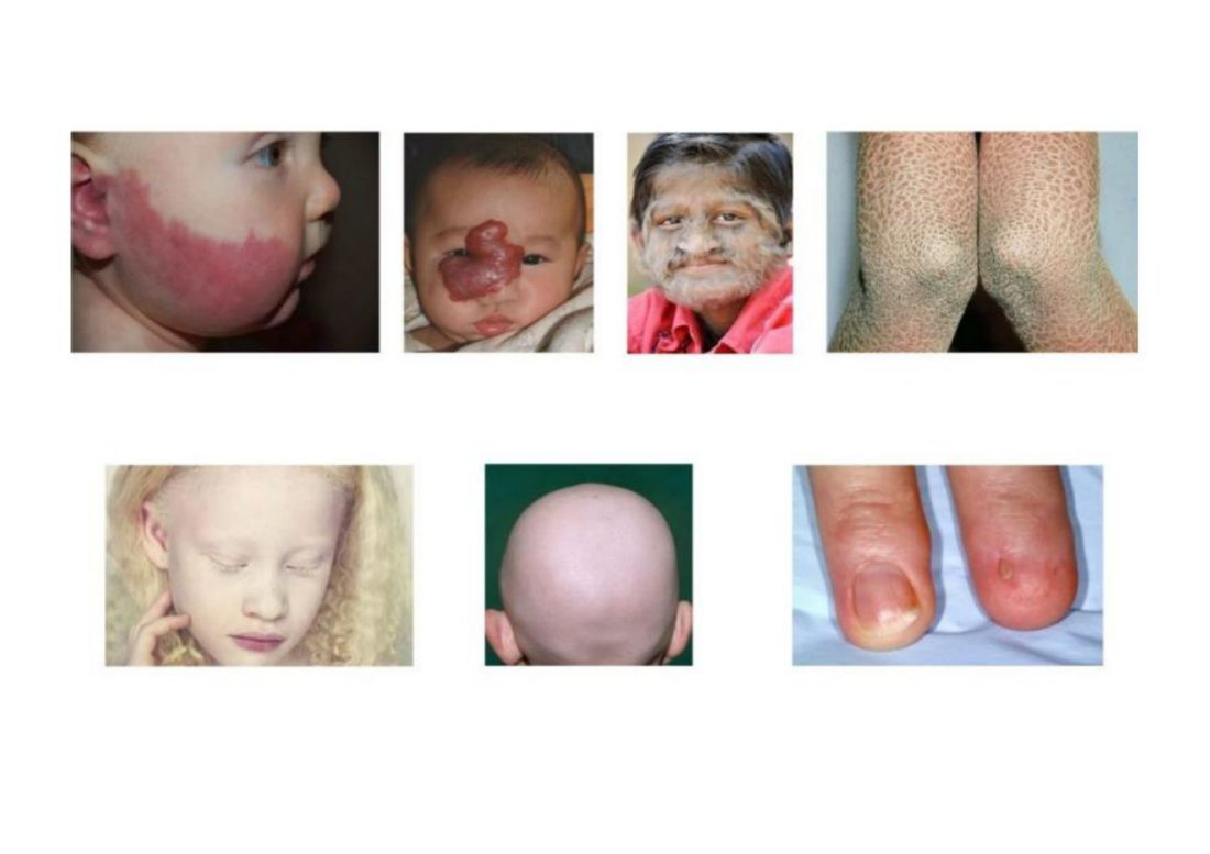 Number 22 - seven photographs of congenital skin and hair anomalies