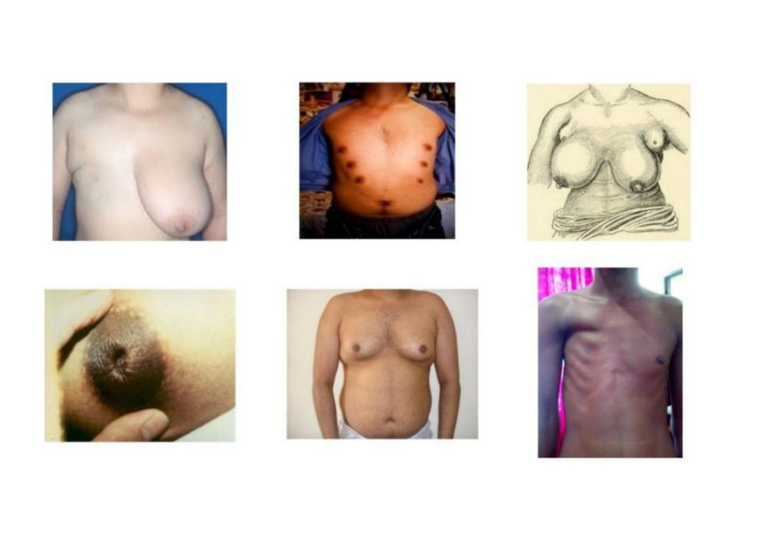 Number 24 - six photographs of congenital breast anomalies