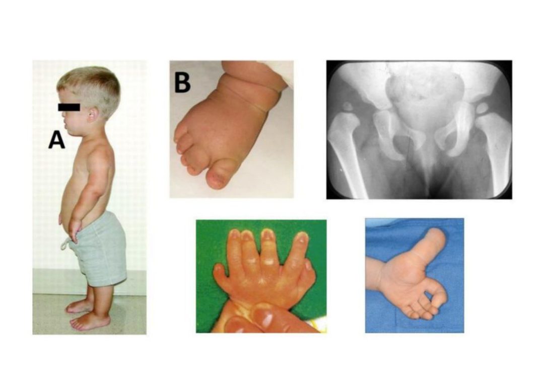 Number 25 - child with short stature, hip X-ray, hand anomaly photos