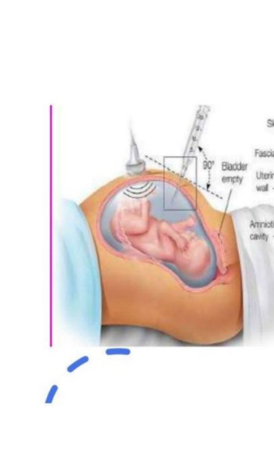 Diagram of a needle sampling the amniotic cavity under ultrasound guidance
