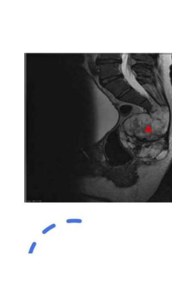 MRI of the sacrum showing a mass labelled A