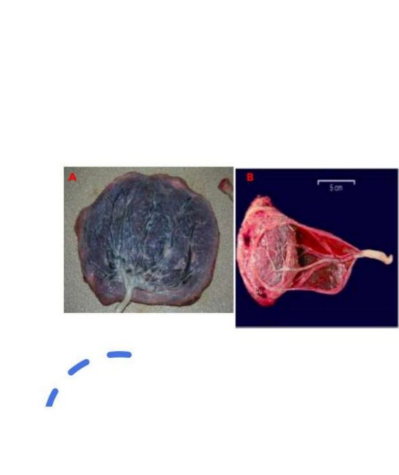 Two placental specimens: A shows a centrally-inserted cord, B shows a cord inserting at the placental margin with a fan of vessels