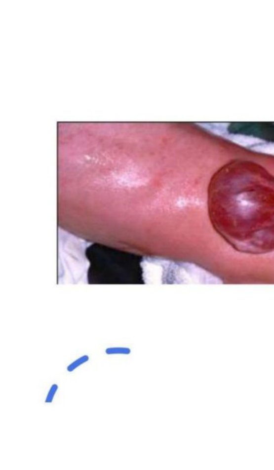 Clinical photo of a large fluctuant swelling over the lower spine