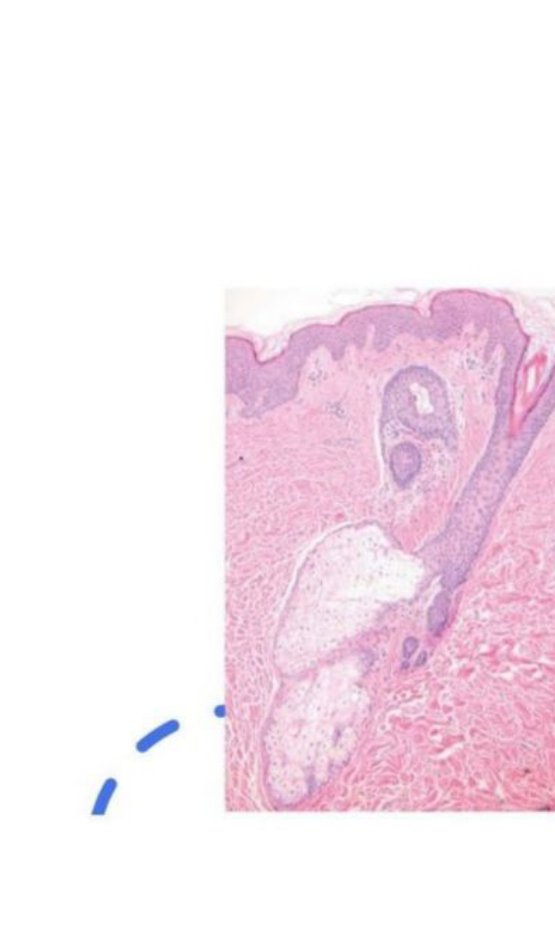 Photomicrograph of skin showing a hair follicle with an attached sebaceous gland