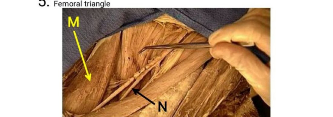 Q5 - femoral triangle dissection with M and N labelled