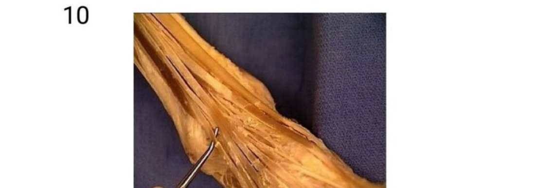 Q10 - ankle dissection with a tendon tagged
