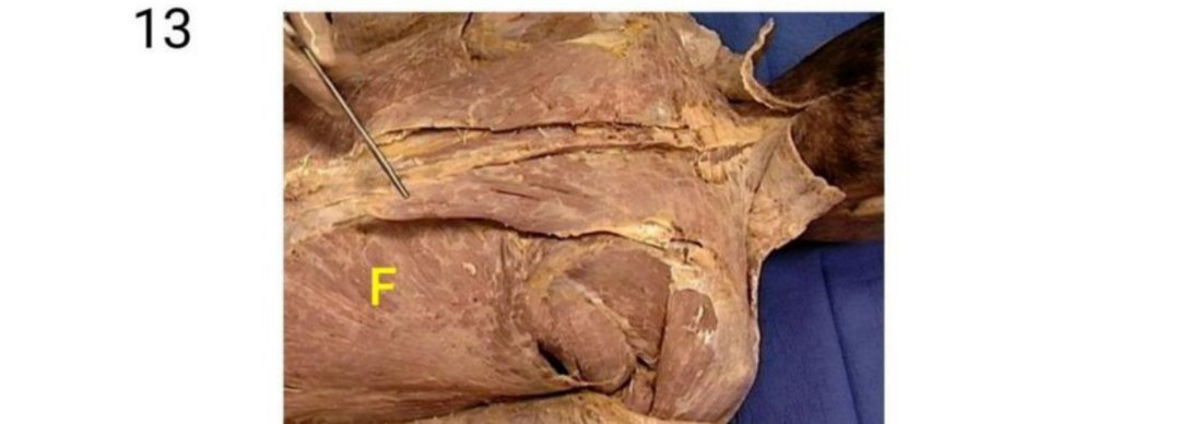 Q13 - back dissection with a muscle tagged F