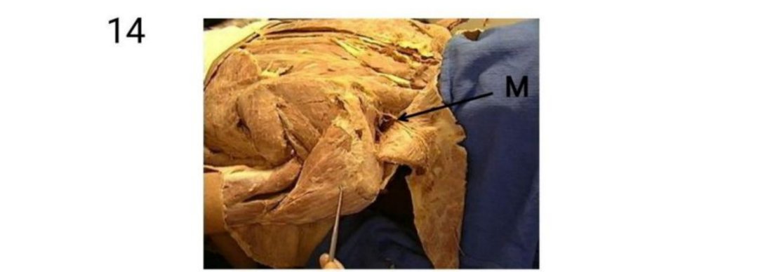 Q14 - shoulder/neck dissection with M tagged