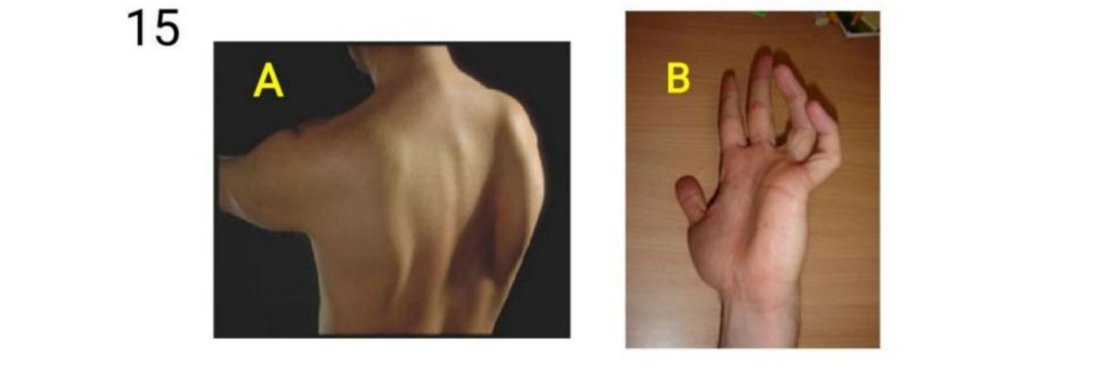 Q15 - winged scapula (A) and clawed hand (B)