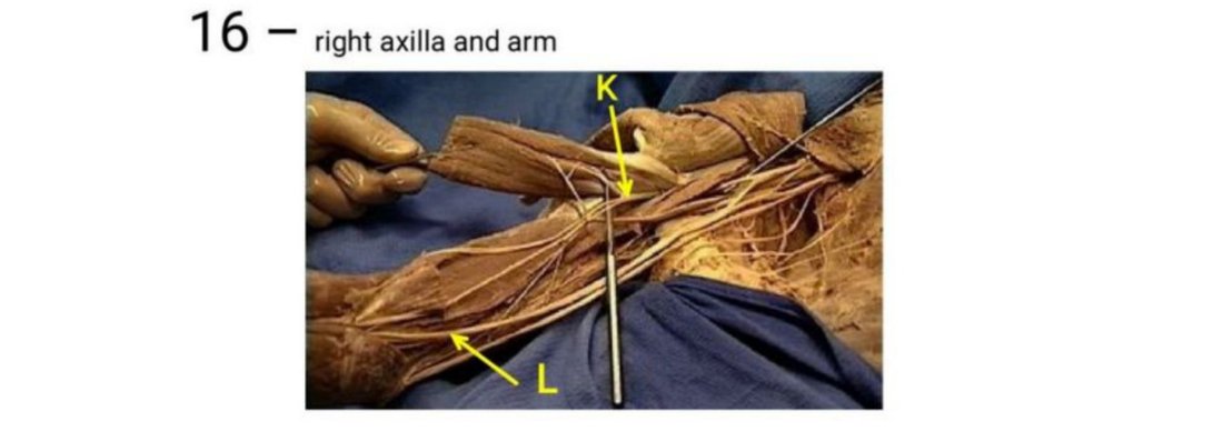 Q16 - right axilla and arm dissection with K and L labelled