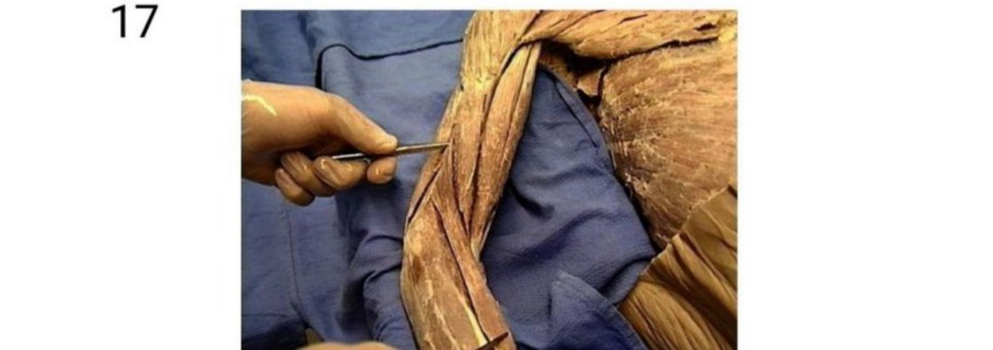 Q17 - forearm dissection with a muscle tagged