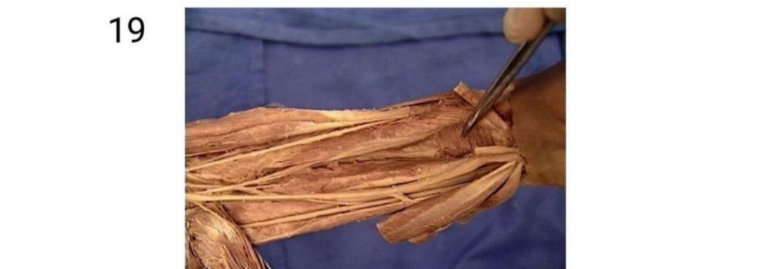 Q19 - forearm dissection at the elbow