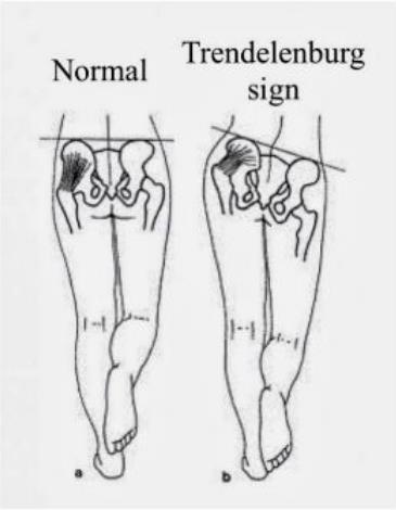 Normal and positive Trendelenburg stance
