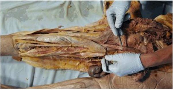 Gluteal and posterior-thigh dissection with the sciatic nerve tagged