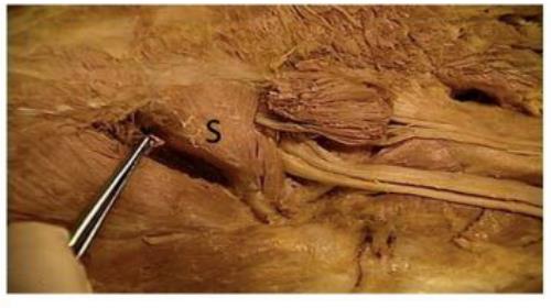 Gluteal dissection with piriformis marked S