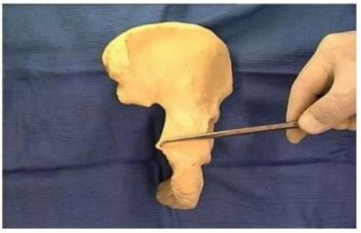 Hip bone with the ischial spine probed
