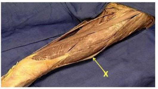 Lateral thigh dissection with the iliotibial tract labelled X