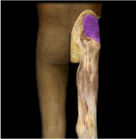 Gluteus medius highlighted at the lateral hip