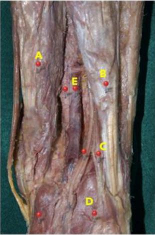 Popliteal fossa dissection labelled A-E